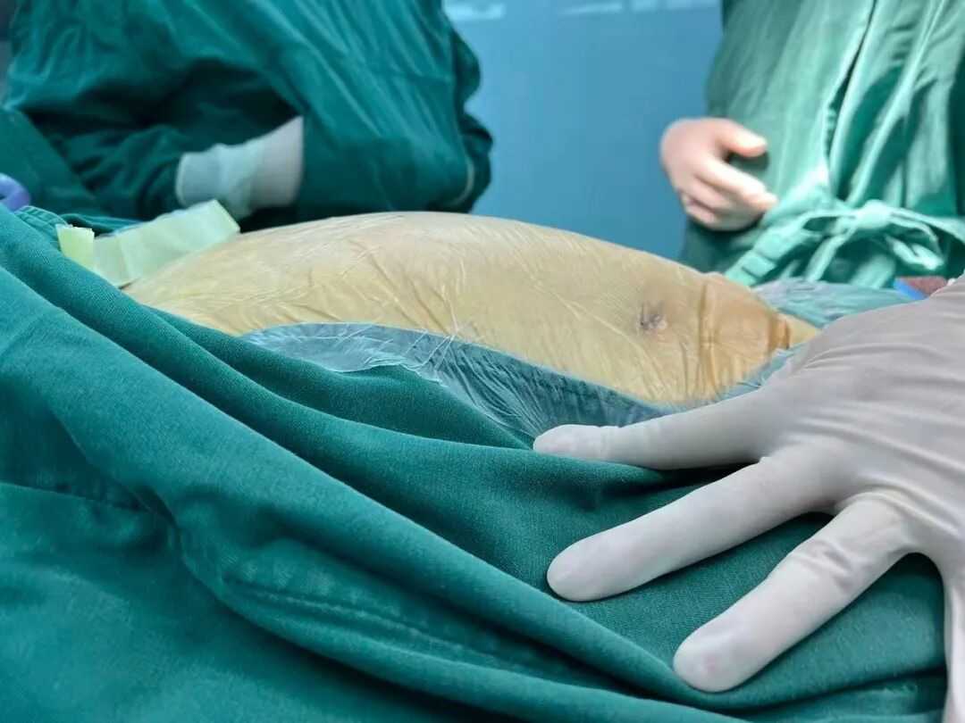 误把肿瘤当发福？漳州阿姨肚子鼓得不对称，一查竟是西瓜大的腹膜后肿瘤