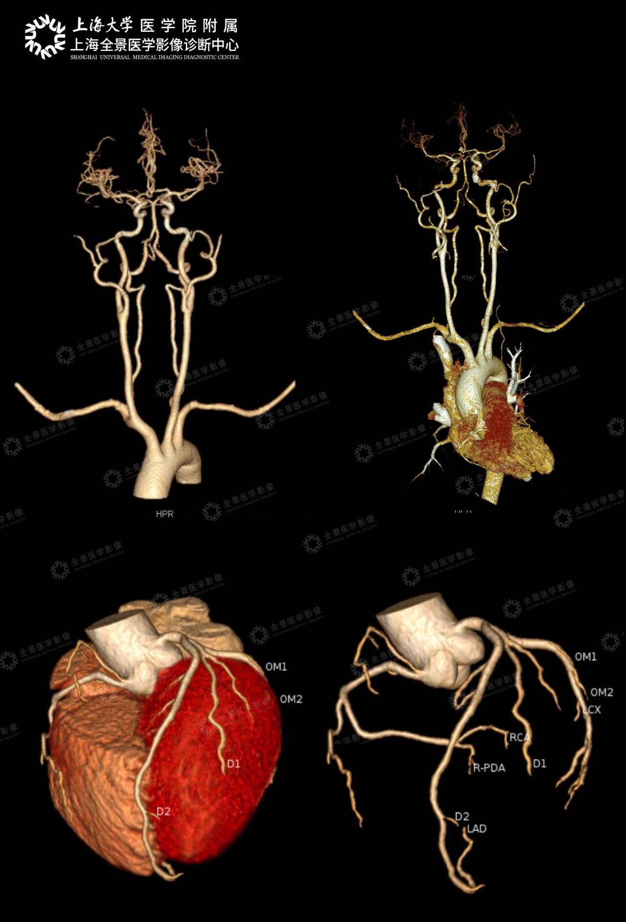 【检诊疗救助全纪实】血管 90%-100% 重度闭塞+易损斑块,如何化险为夷?