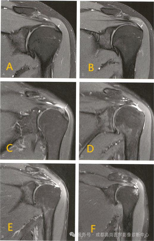 【高尚病例】MRI 右肩平扫诊断冈上肌腱断裂 1 例
