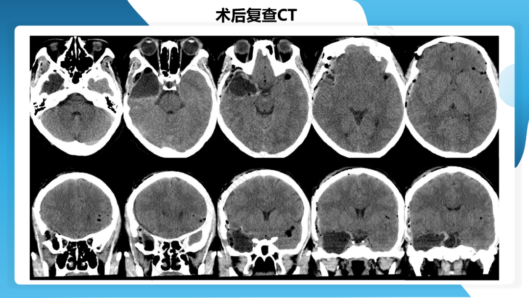 《「痫停」信步》癫痫治疗病例荟萃第三十七期---颞叶海绵状血管瘤相关癫痫的手术治疗一例
