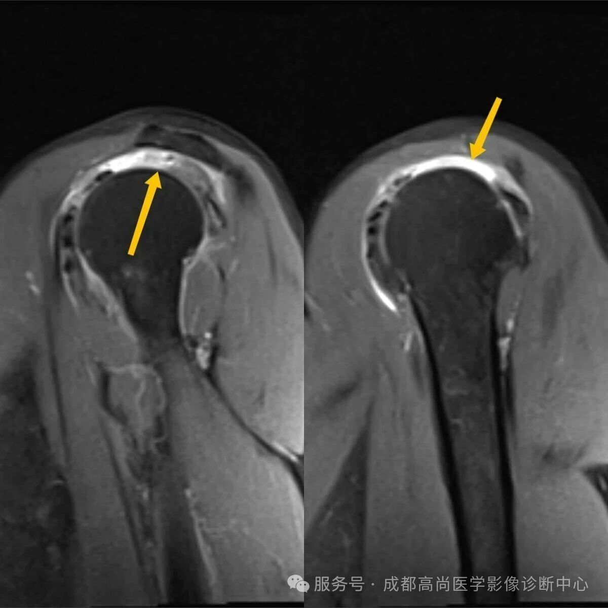 【高尚病例】MRI 右肩平扫诊断冈上肌腱断裂 1 例