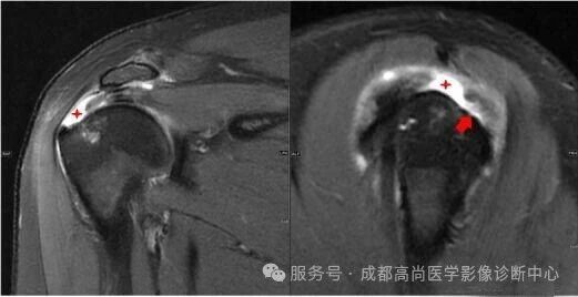 【高尚病例】MRI 右肩平扫诊断冈上肌腱断裂 1 例