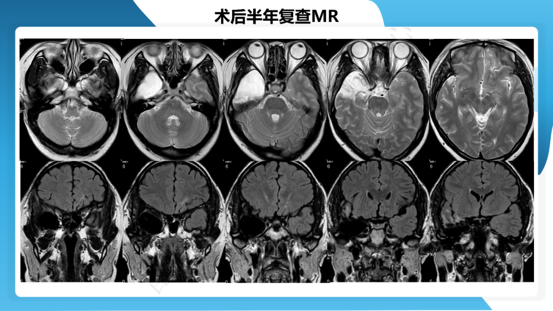 《「痫停」信步》癫痫治疗病例荟萃第三十七期---颞叶海绵状血管瘤相关癫痫的手术治疗一例