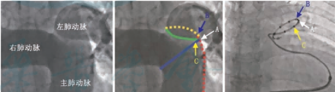 南大二附院心内科成功开展肺动脉神经节消融术
