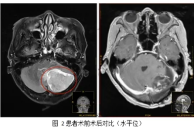 生命禁区里的精准「拆弹」 | 我院神经外科助颅内肿瘤患者重获新生