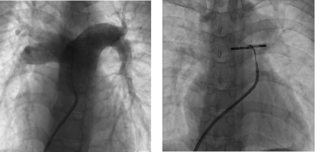 南大二附院心内科成功开展肺动脉神经节消融术