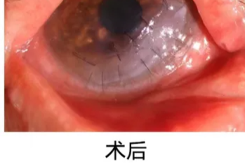 她守护一个家，我们用光明守护她——辽宁爱尔眼科医院联合公益项目助坚强母亲复明