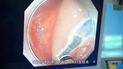 80% 消化早癌没症状?这样查最靠谱