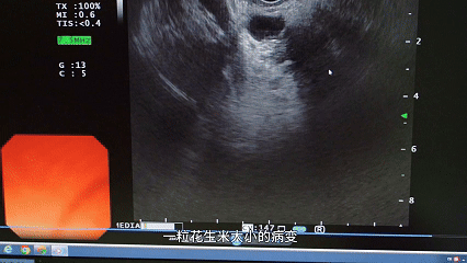 80% 消化早癌没症状?这样查最靠谱