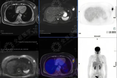 当「医疗级深度健检」发挥作用：让她从「无症状」到及时抓住乳腺癌的踪迹！