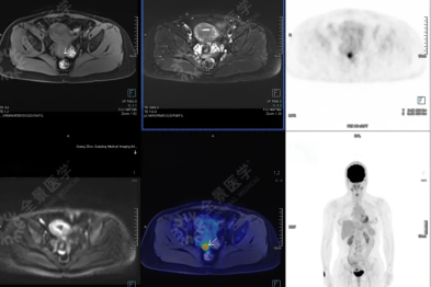 粉红十月警钟！年仅 38 岁，PET/MR 揪出宫颈+乳腺双隐患，常规体检为何没发现？