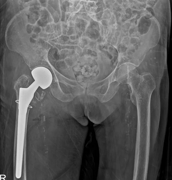 广西医科大一附院成功实施高龄患者心脏冠脉支架术后人工股骨头置换术