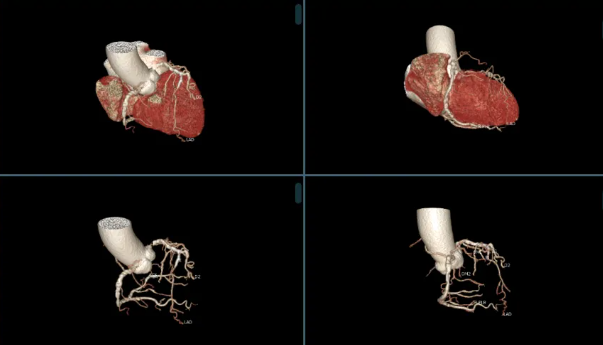 广西医科大一附院成功实施高龄患者心脏冠脉支架术后人工股骨头置换术