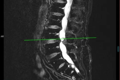 一次手术 治两种病|脊柱骨病外科用 AUSS 技术一并解除侧隐窝狭窄和椎管内肿瘤