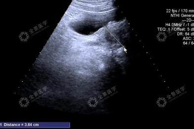 2 年体检 B 超显示「增生、钙化」，却突然患癌！深度体检的重要性不容忽视