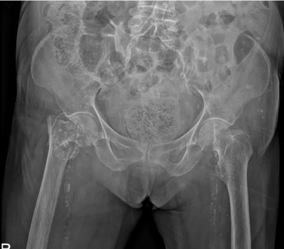 广西医科大一附院成功实施高龄患者心脏冠脉支架术后人工股骨头置换术