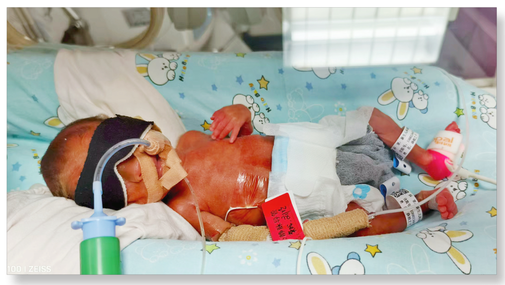 「从未想过放弃!」生死竞速 88 天,西北妇儿成功救下 24 周超早产宝宝