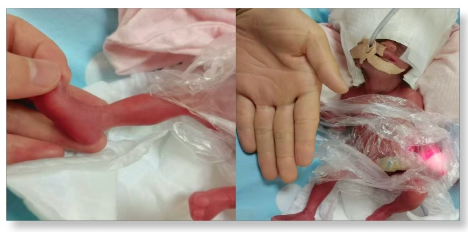 「从未想过放弃!」生死竞速 88 天,西北妇儿成功救下 24 周超早产宝宝