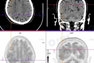 精准影像破局 AD！阿尔茨海默病诊断 「金标准」 首批落地全景医学北京中心