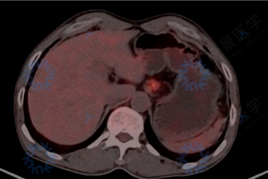 吞咽困难的影像诊断：PET/CT 如何提供关键信息