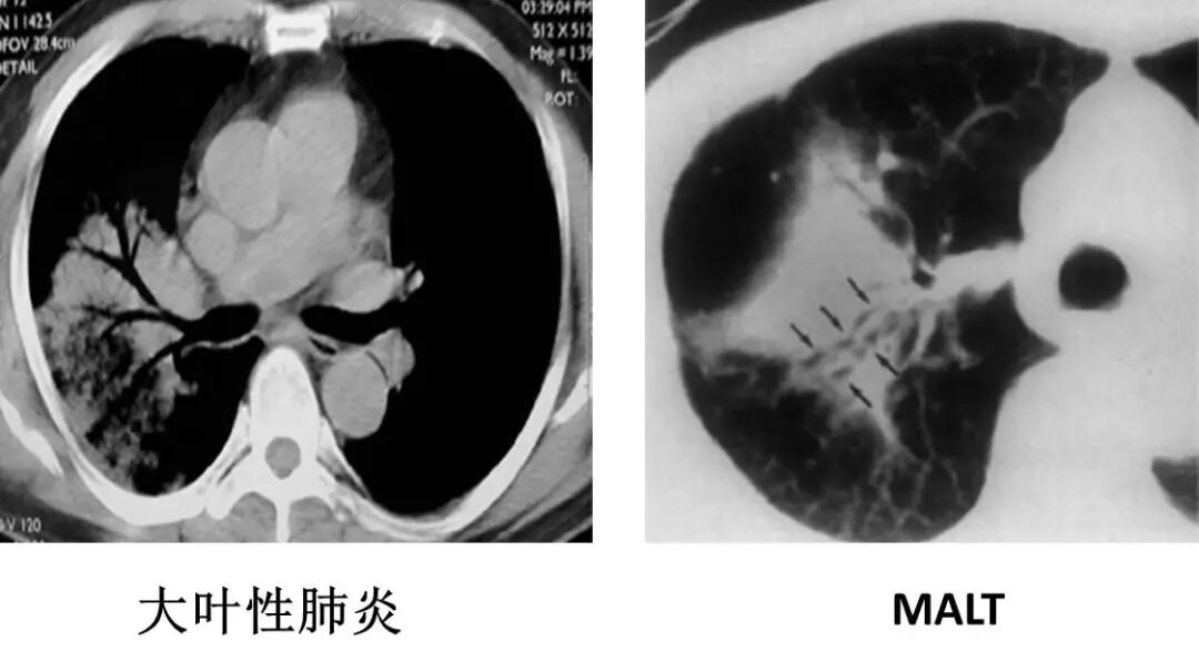 【高尚病例】PET-CT 肺部疑难病例一例分享