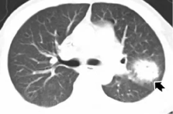 【高尚病例】肺曲霉菌病——「塔宾曲霉」