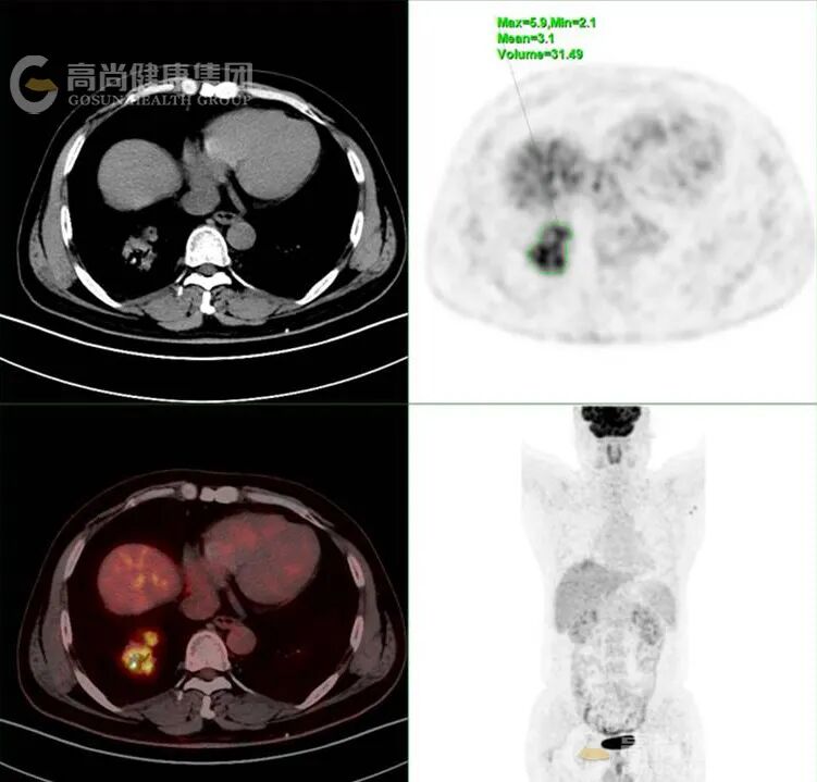 【高尚病例】PET-CT 肺部疑难病例一例分享