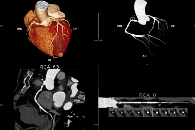 冠心病检查之后以为就是结束，没想到主任一通视频会议紧急响起……