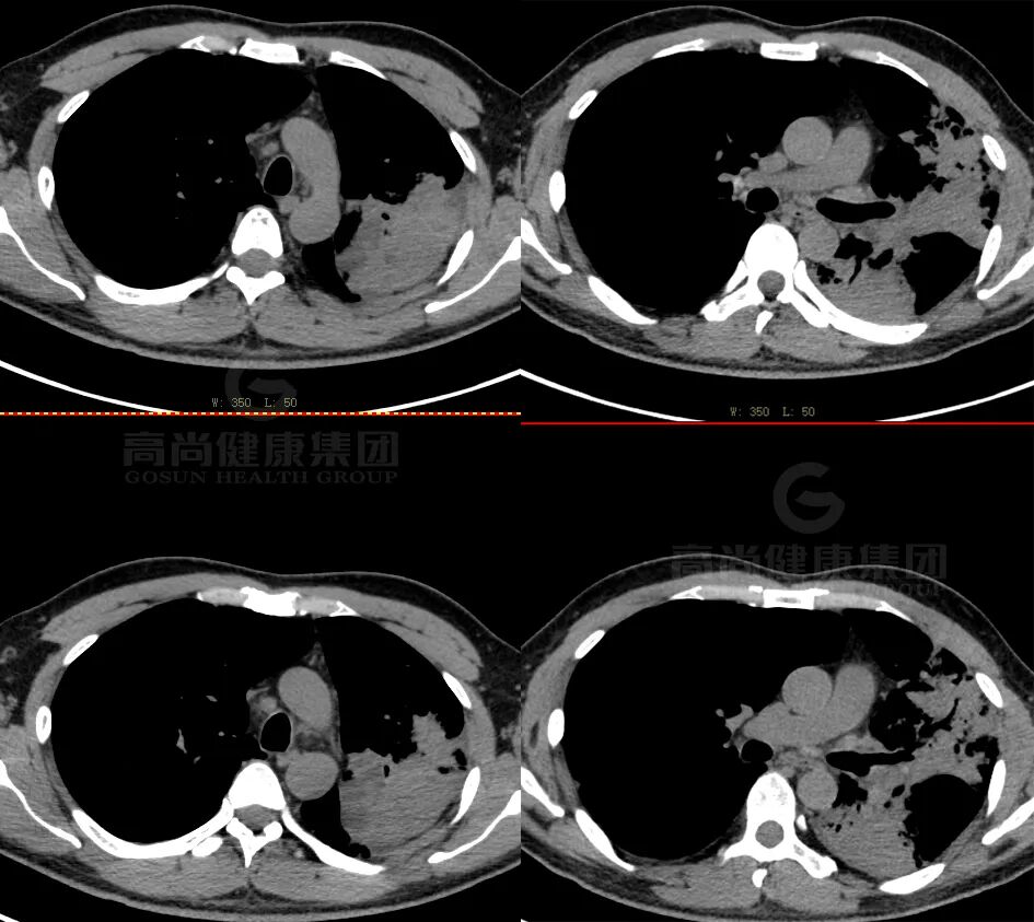 【高尚病例】肺曲霉菌病——「塔宾曲霉」