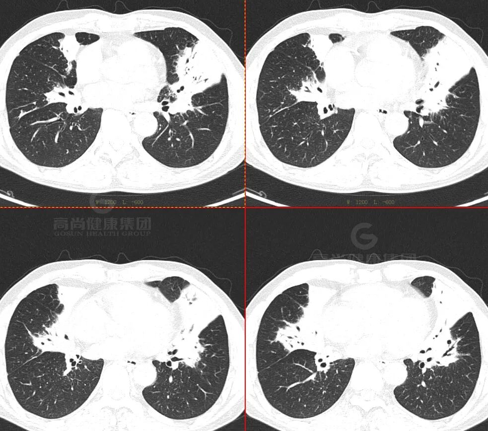 【高尚病例】肺曲霉菌病——「塔宾曲霉」