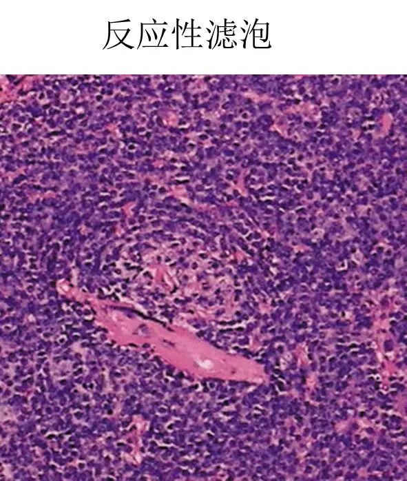 【高尚病例】PET-CT 肺部疑难病例一例分享