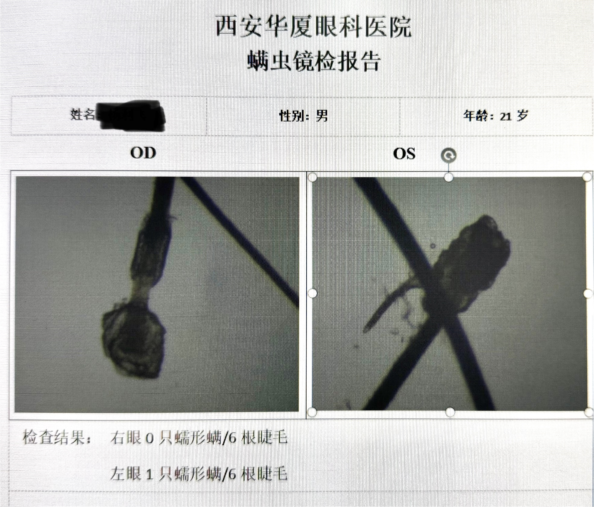 眼部蠕形螨感染治疗：坚持规范治疗的核心必要性与防止复发的科学依据