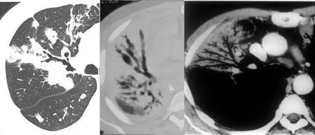【高尚病例】PET-CT 肺部疑难病例一例分享