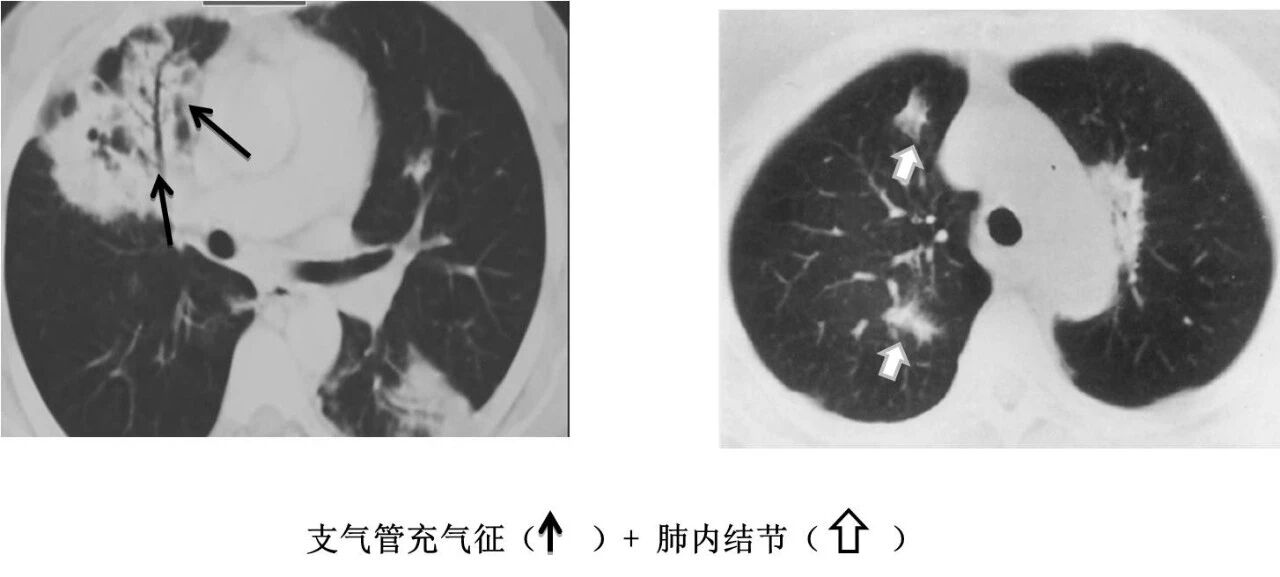 【高尚病例】PET-CT 肺部疑难病例一例分享
