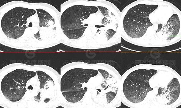 【高尚病例】肺曲霉菌病——「塔宾曲霉」