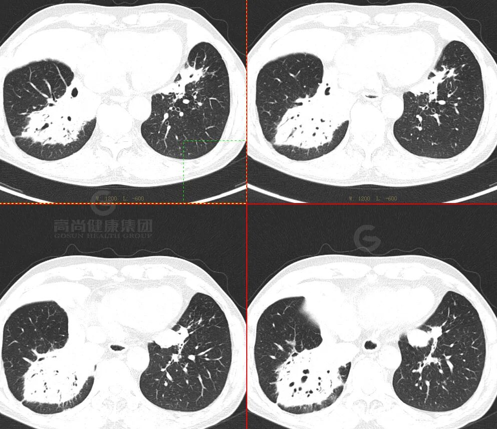 【高尚病例】肺曲霉菌病——「塔宾曲霉」