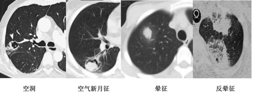 【高尚病例】PET-CT 肺部疑难病例一例分享
