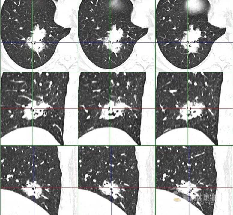 【高尚病例】PET-CT 肺部疑难病例一例分享