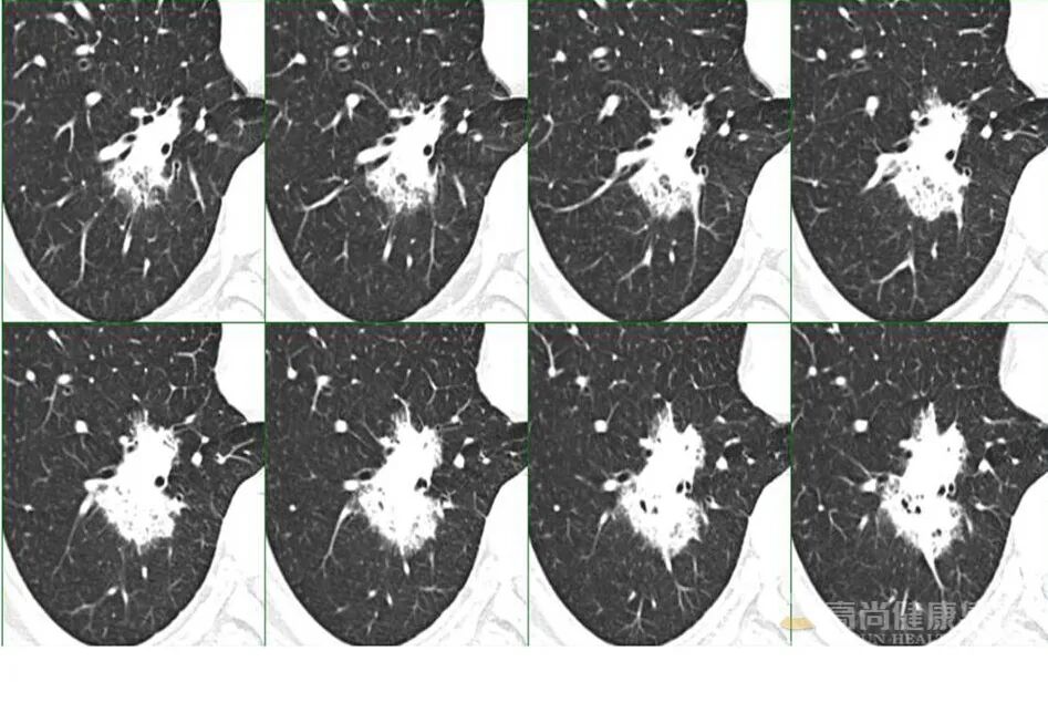 【高尚病例】PET-CT 肺部疑难病例一例分享