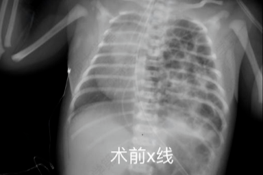 生死 24 小时！交大一附院多学科联动，为出生 1 天的「膈疝宝宝」抢回生机