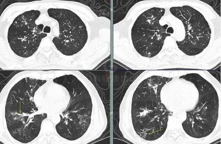 【高尚病例】肺曲霉菌病——「塔宾曲霉」