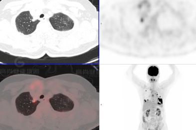 【高尚病例】肺曲霉菌病——「塔宾曲霉」