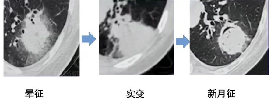 【高尚病例】肺曲霉菌病——「塔宾曲霉」