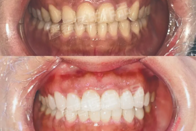 做牙贴面就像做美甲？专业牙医揭秘，别再上当了！