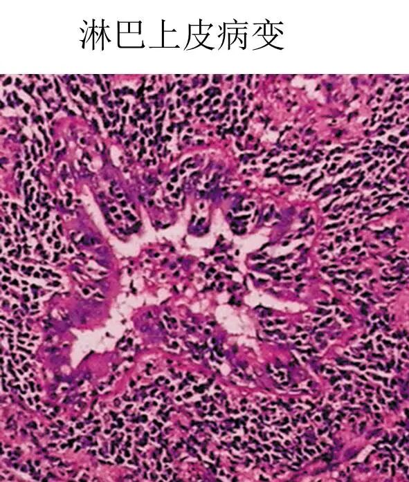 【高尚病例】PET-CT 肺部疑难病例一例分享