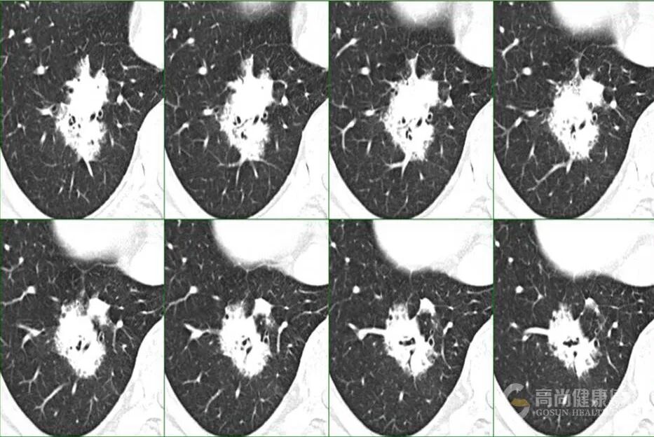 【高尚病例】PET-CT 肺部疑难病例一例分享