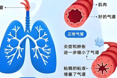 慢阻肺用药宝典：认清这些药，避开这些「坑」