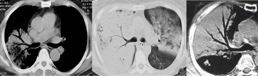 【高尚病例】PET-CT 肺部疑难病例一例分享