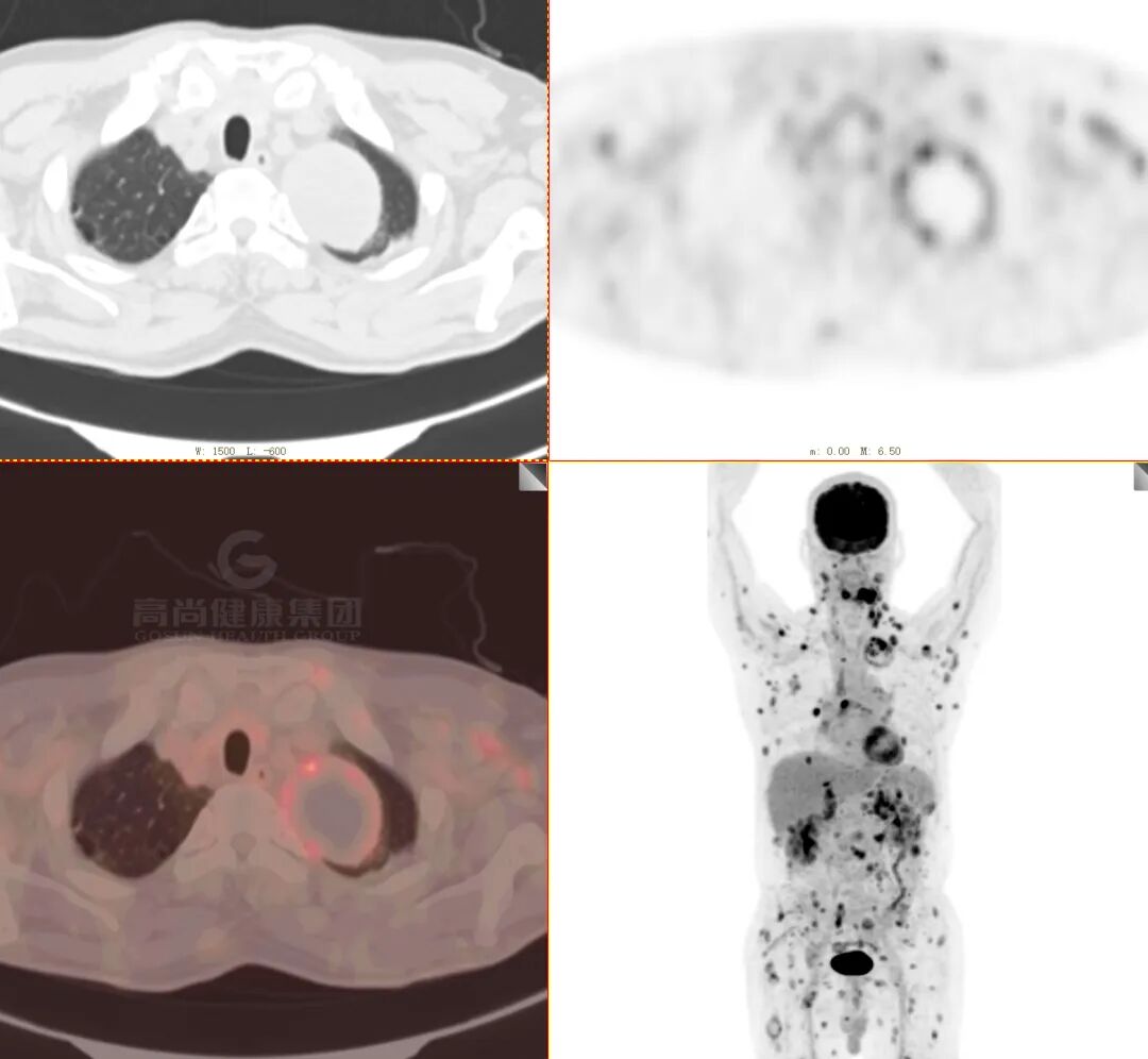 【高尚病例】肺曲霉菌病——「塔宾曲霉」