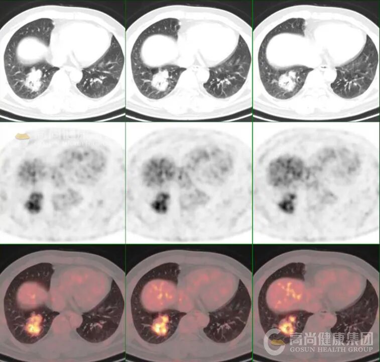 【高尚病例】PET-CT 肺部疑难病例一例分享